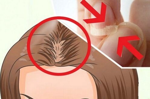 problemi con capelli e unghie dovuti a parassiti